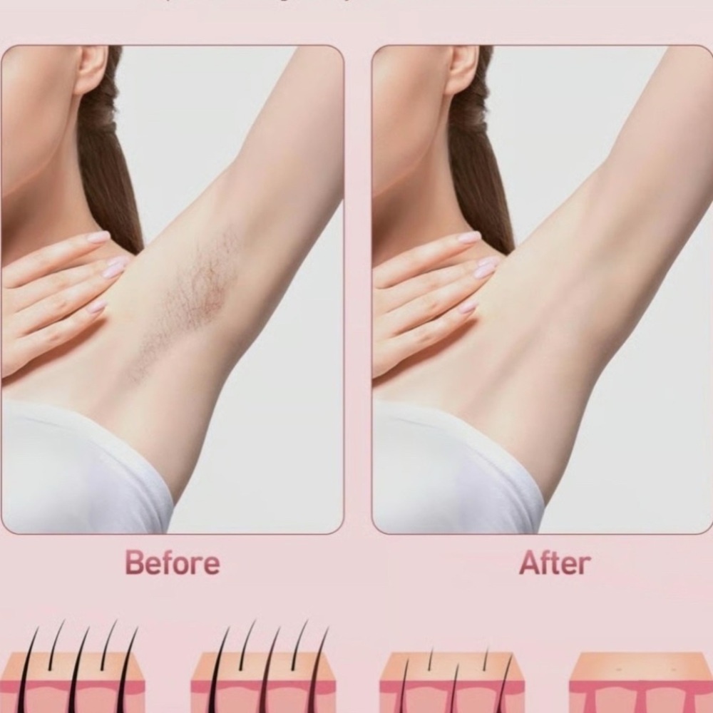 IPL Hair Removal Device - Pink - Picture 6 of 6